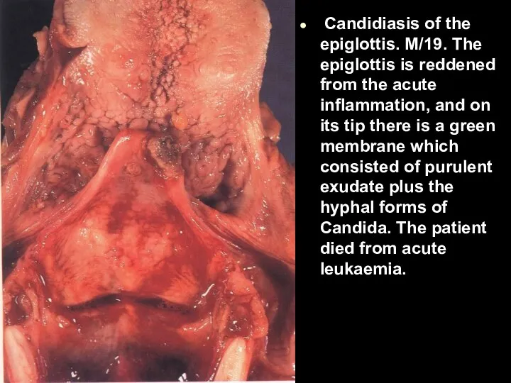 Candidiasis of the epiglottis. M/19. The epiglottis is reddened from the acute inflammation,