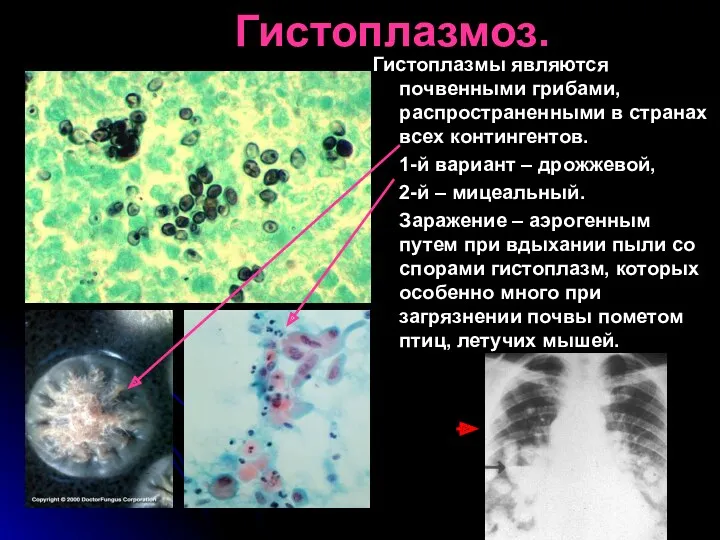 Гистоплазмоз. Гистоплазмы являются почвенными грибами, распространенными в странах всех контингентов.