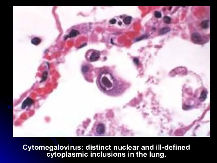 Cytomegalovirus: distinct nuclear and ill-defined cytoplasmic inclusions in the lung.