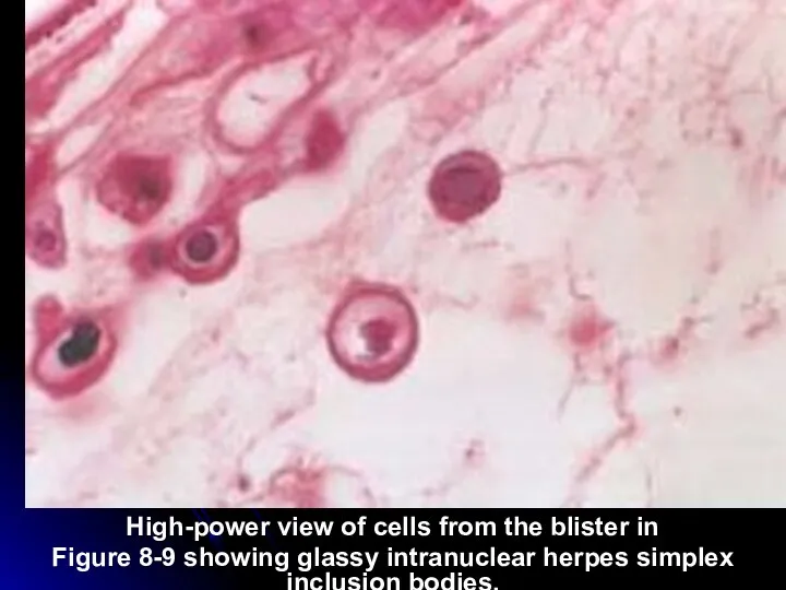 High-power view of cells from the blister in Figure 8-9 showing glassy intranuclear