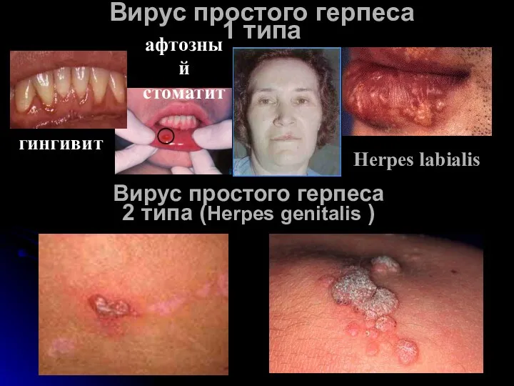 Вирус простого герпеса 1 типа Вирус простого герпеса 2 типа (Herpes genitalis )