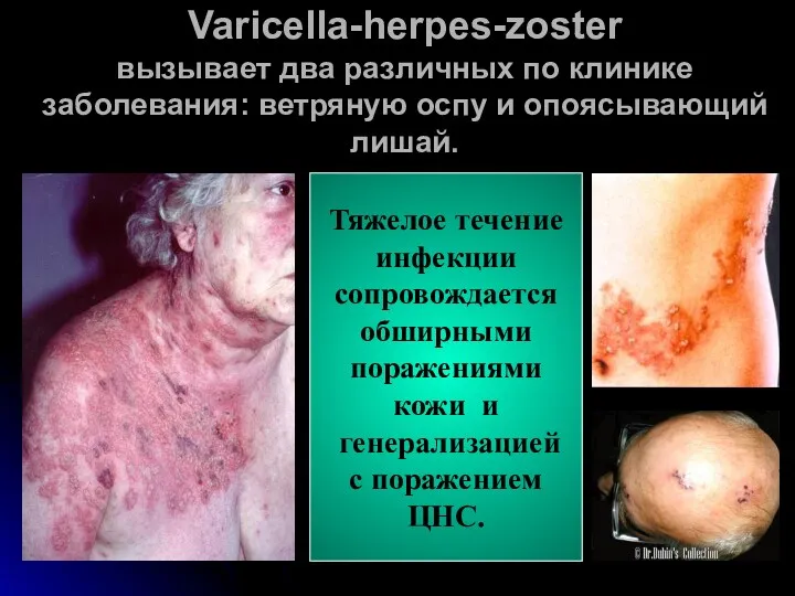 Varicella-herpes-zoster вызывает два различных по клинике заболевания: ветряную оспу и опоясывающий лишай. Тяжелое