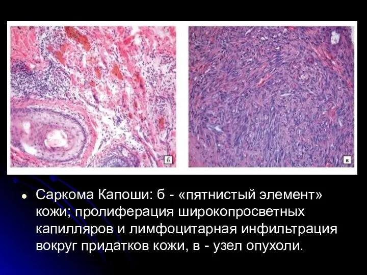 Саркома Капоши: б - «пятнистый элемент» кожи; пролиферация широкопросветных капилляров и лимфоцитарная инфильтрация