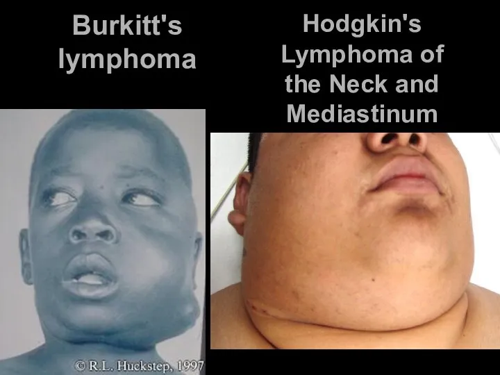 Burkitt's lymphoma Hodgkin's Lymphoma of the Neck and Mediastinum