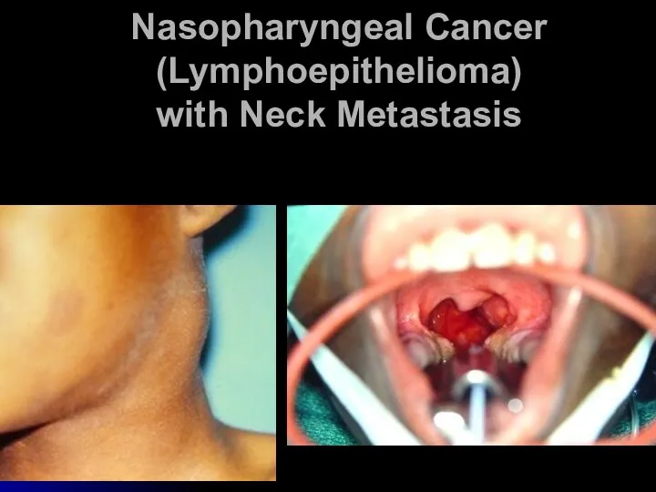 Nasopharyngeal Cancer (Lymphoepithelioma) with Neck Metastasis