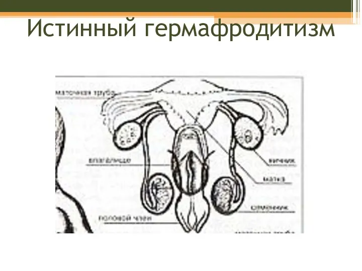 Истинный гермафродитизм