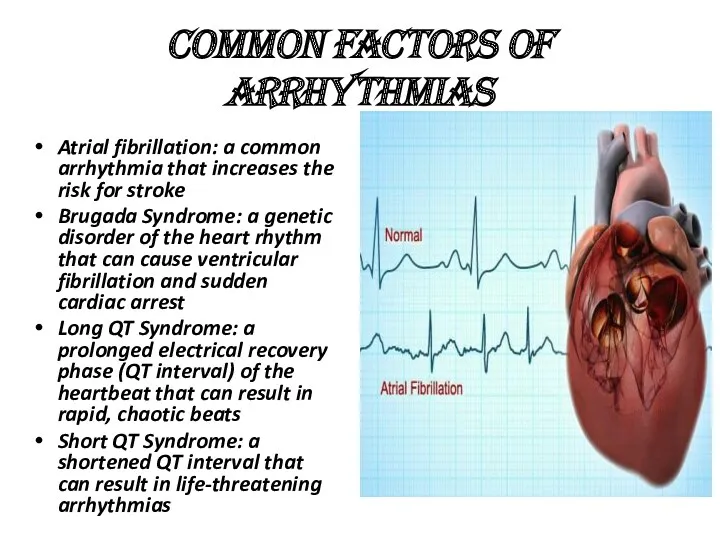 Common factors of arrhythmias Atrial fibrillation: a common arrhythmia that