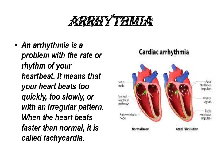 ARRHYTHMIA An arrhythmia is a problem with the rate or