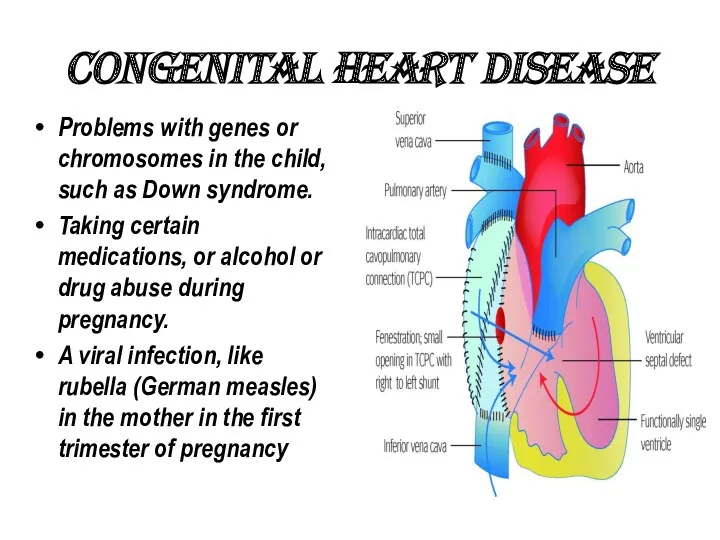 CONGENITAL HEART DISEASE Problems with genes or chromosomes in the