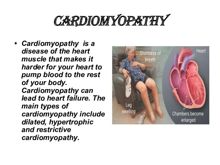 CARDIOMYOPATHY Cardiomyopathy is a disease of the heart muscle that