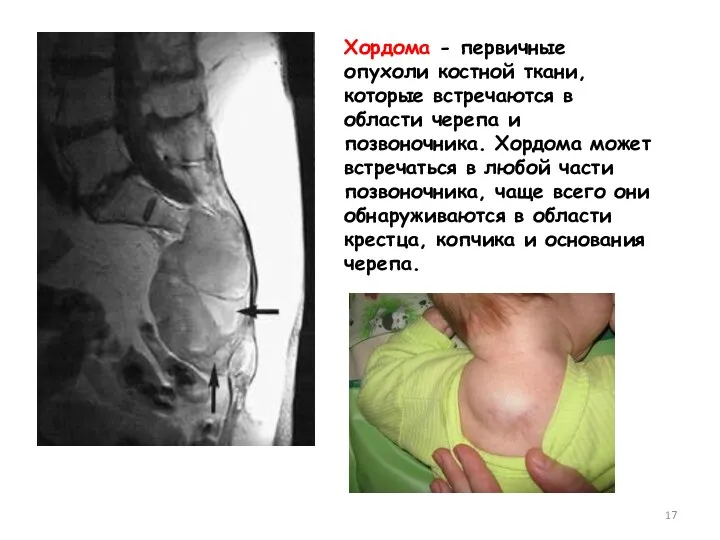 Хордома - первичные опухоли костной ткани, которые встречаются в области