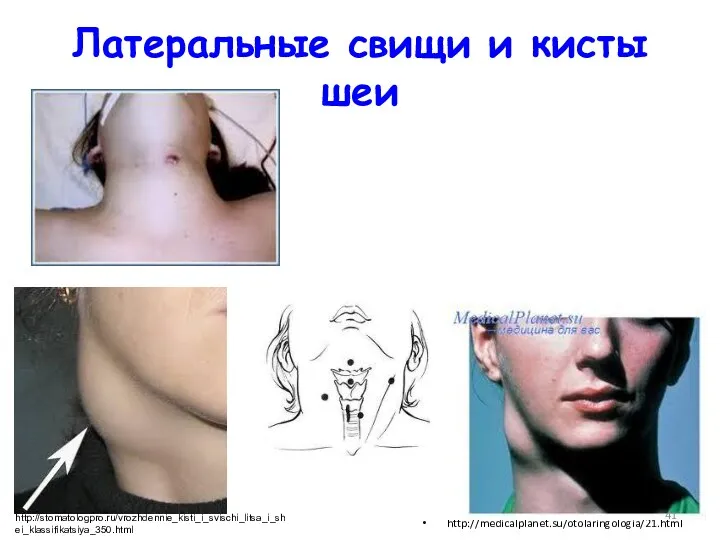 Латеральные свищи и кисты шеи http://medicalplanet.su/otolaringologia/21.html http://stomatologpro.ru/vrozhdennie_kisti_i_svischi_litsa_i_shei_klassifikatsiya_350.html