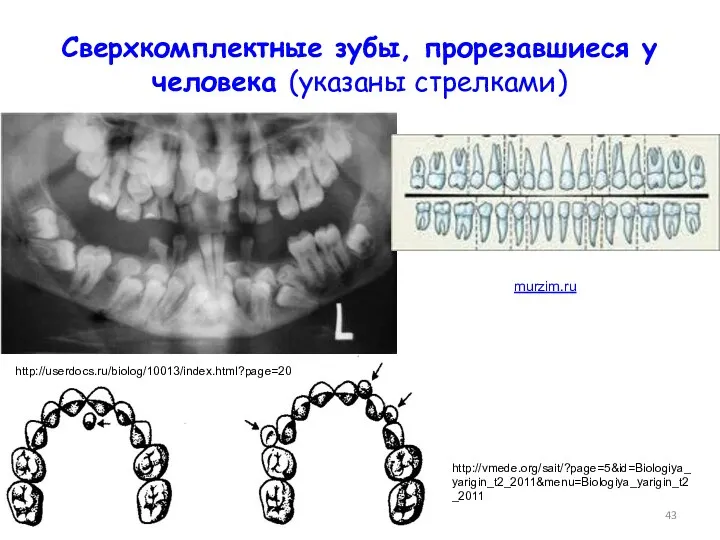 Сверхкомплектные зубы, прорезавшиеся у человека (указаны стрелками) http://userdocs.ru/biolog/10013/index.html?page=20 http://vmede.org/sait/?page=5&id=Biologiya_yarigin_t2_2011&menu=Biologiya_yarigin_t2_2011 murzim.ru