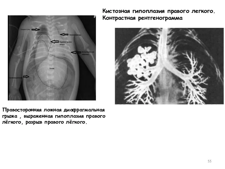 Кистозная гипоплазия правого легкого. Контрастная рентгенограмма Правосторонняя ложная диафрагмальная грыжа