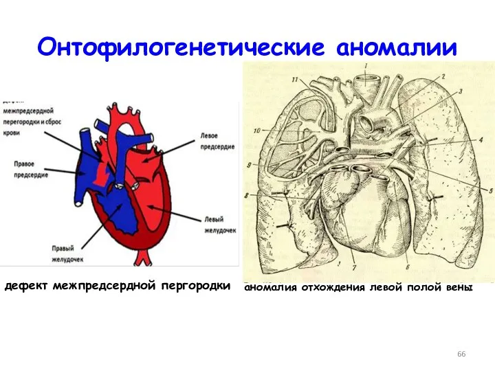 Онтофилогенетические аномалии аномалия отхождения левой полой вены дефект межпредсердной пергородки