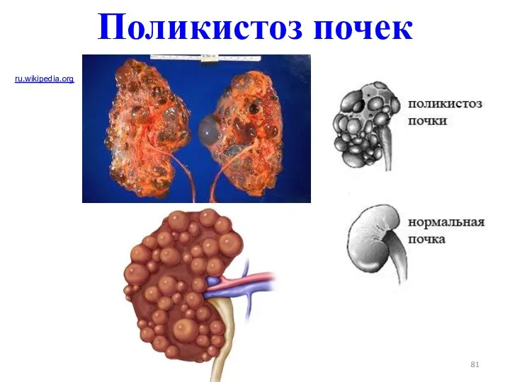 Поликистоз почек ru.wikipedia.org