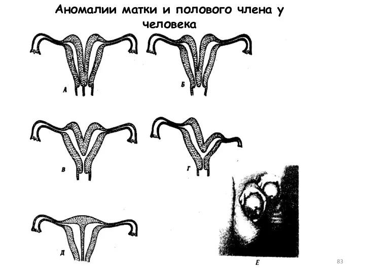 Аномалии матки и полового члена у человека