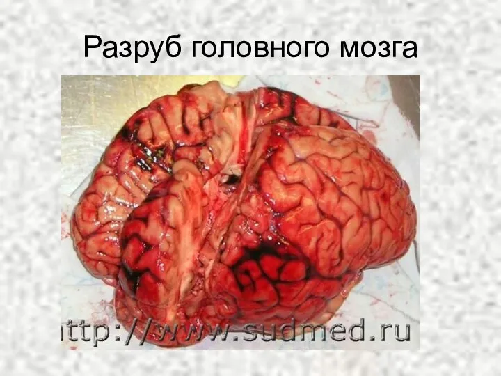 Разруб головного мозга