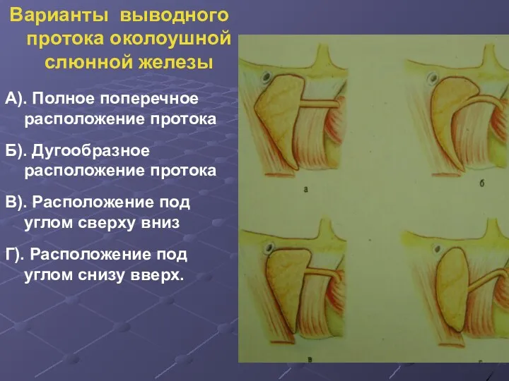 Варианты выводного протока околоушной слюнной железы А). Полное поперечное расположение