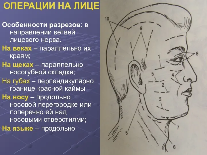 ОПЕРАЦИИ НА ЛИЦЕ Особенности разрезов: в направлении ветвей лицевого нерва.