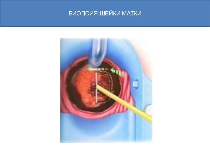 БИОПСИЯ ШЕЙКИ МАТКИ