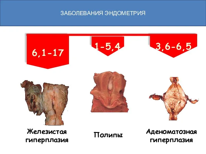 6,1-17 1-5,4 3,6-6,5 Железистая гиперплазия Полипы Аденоматозная гиперплазия ЗАБОЛЕВАНИЯ ЭНДОМЕТРИЯ