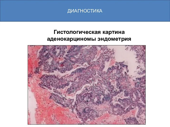 Гистологическая картина аденокарциномы эндометрия ДИАГНОСТИКА
