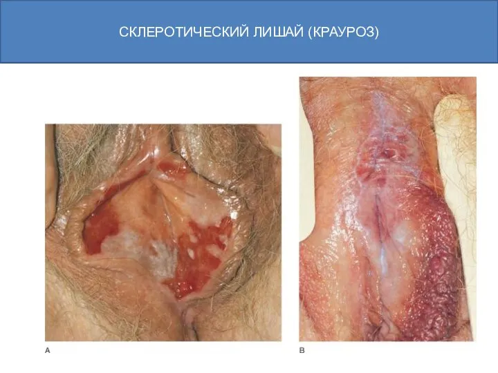 РУДН, кафедра акушерства и гинекологии с курсом перинатологии СКЛЕРОТИЧЕСКИЙ ЛИШАЙ (КРАУРОЗ)