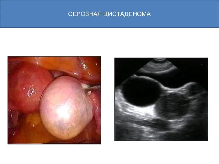 СЕРОЗНАЯ ЦИСТАДЕНОМА