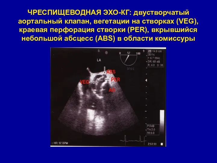 ЧРЕСПИЩЕВОДНАЯ ЭХО-КГ: двустворчатый аортальный клапан, вегетации на створках (VEG), краевая перфорация створки (PER),