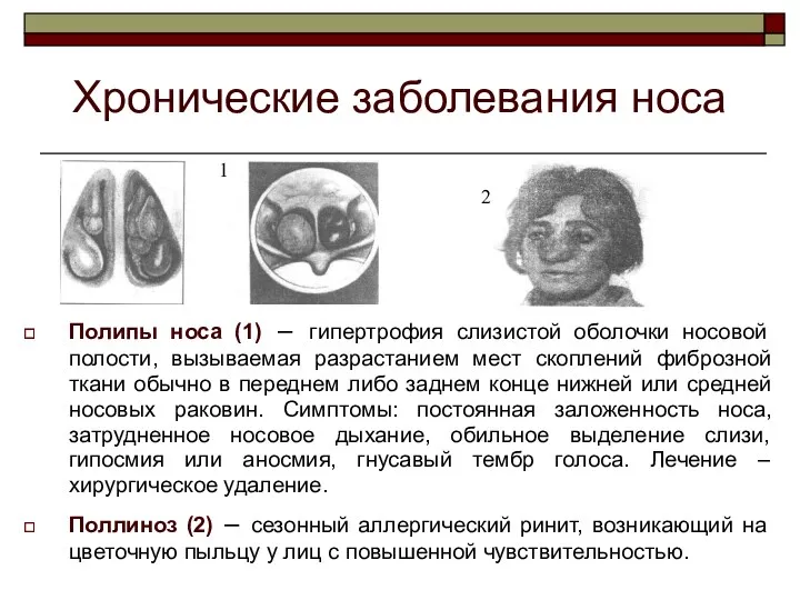 Хронические заболевания носа Полипы носа (1) – гипертрофия слизистой оболочки