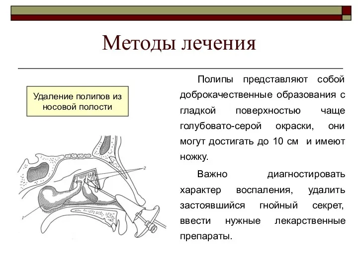 Методы лечения Полипы представляют собой доброкачественные образования с гладкой поверхностью