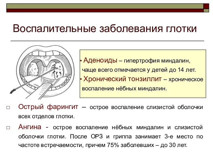 Воспалительные заболевания глотки Острый фарингит – острое воспаление слизистой оболочки