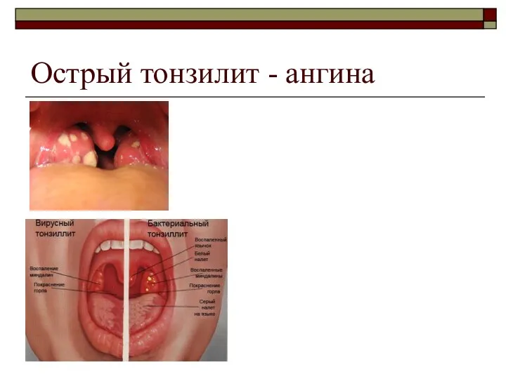 Острый тонзилит - ангина