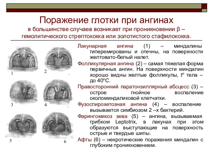 Поражение глотки при ангинах в большинстве случаев возникает при проникновении