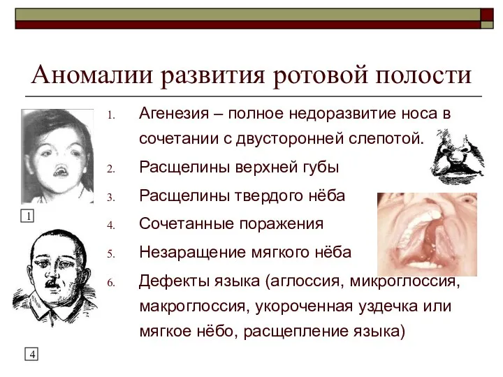 Аномалии развития ротовой полости Агенезия – полное недоразвитие носа в