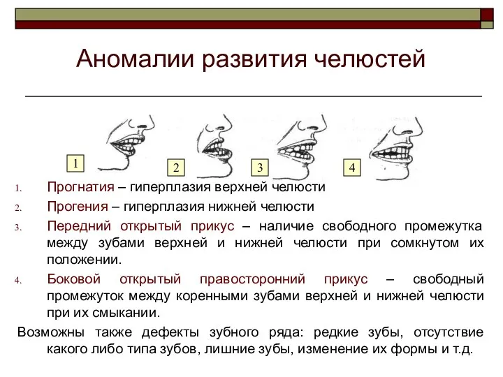 Аномалии развития челюстей Прогнатия – гиперплазия верхней челюсти Прогения –