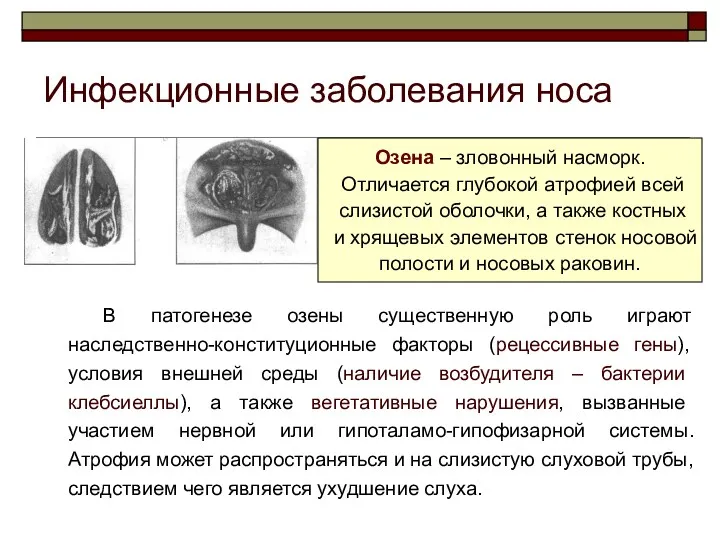 Инфекционные заболевания носа В патогенезе озены существенную роль играют наследственно-конституционные