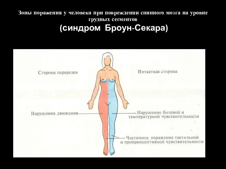 Зоны поражения у человека при повреждении спинного мозга на уровне грудных сегментов (синдром Броун-Секара)