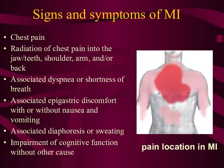 Signs and symptoms of MI Chest pain Radiation of chest