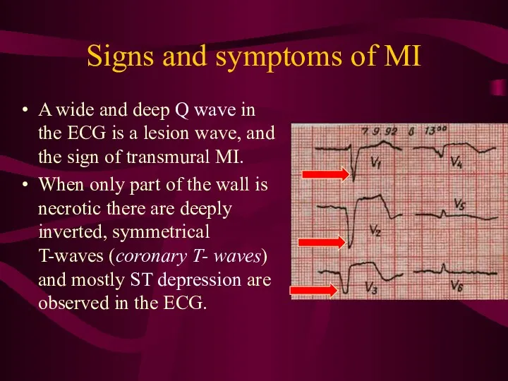 Signs and symptoms of MI A wide and deep Q