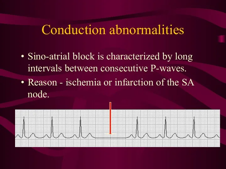 Conduction abnormalities Sino-atrial block is characterized by long intervals between