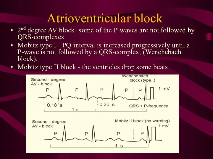 Atrioventricular block 2nd degree AV block- some of the P-waves