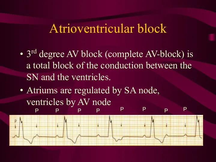 Atrioventricular block 3rd degree AV block (complete AV-block) is a