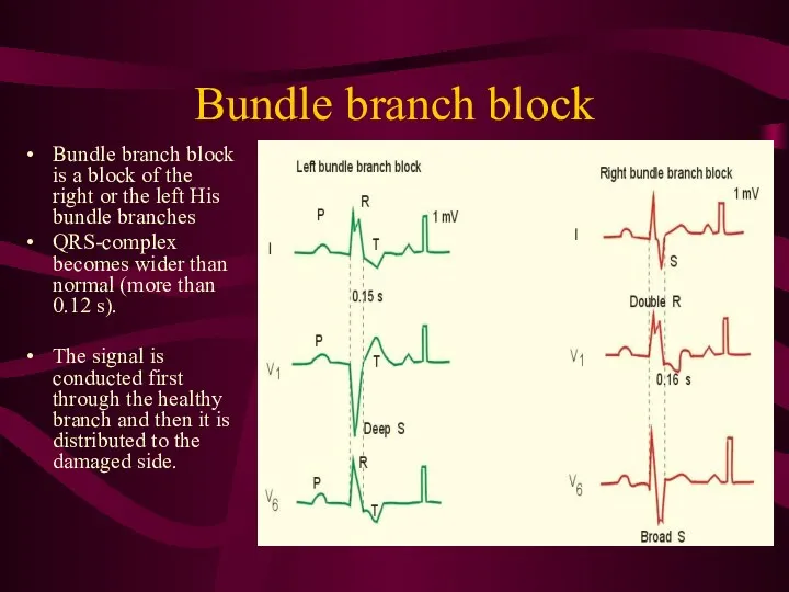 Bundle branch block Bundle branch block is a block of