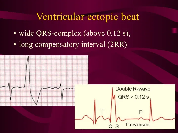 Ventricular ectopic beat wide QRS-complex (above 0.12 s), long compensatory interval (2RR)