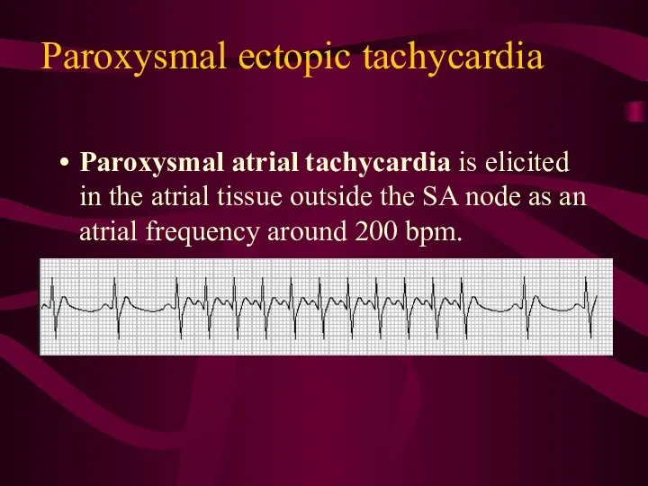 Paroxysmal ectopic tachycardia Paroxysmal atrial tachycardia is elicited in the
