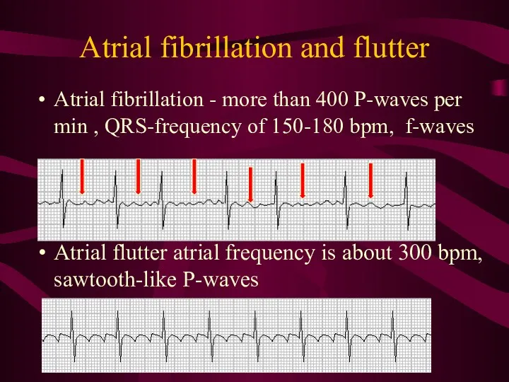 Atrial fibrillation and flutter Atrial fibrillation - more than 400