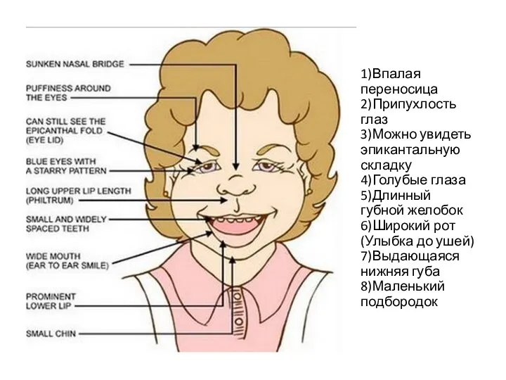 1)Впалая переносица 2)Припухлость глаз 3)Можно увидеть эпикантальную складку 4)Голубые глаза