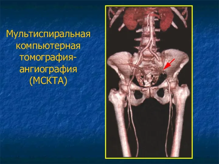 Мультиспиральная компьютерная томография-ангиография (МСКТА)